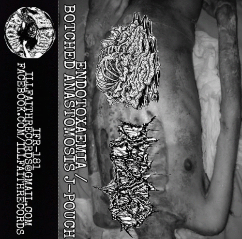 Botched Anastomosis J-Pouch : Vitriolage Deformity